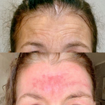 Antes e depois do Protocolo Line Skin na Clínica Harmodont em Sorocaba – evolução da qualidade da pele