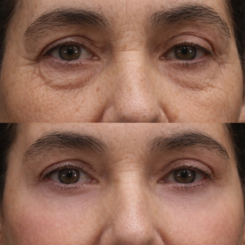 Antes e depois do Protocolo Line Skin na Clínica Harmodont em Sorocaba – evolução da qualidade da pele