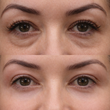 Antes e depois do Protocolo Line Skin na Clínica Harmodont em Sorocaba – evolução da qualidade da pele