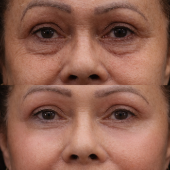 Antes e depois do Protocolo Line Skin na Clínica Harmodont em Sorocaba – evolução da qualidade da pele