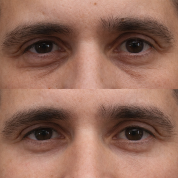 Antes e depois do Protocolo Line Skin na Clínica Harmodont em Sorocaba – evolução da qualidade da pele