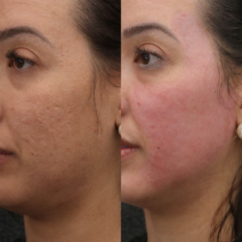 Antes e depois do Protocolo Line Skin na Clínica Harmodont em Sorocaba – evolução da qualidade da pele